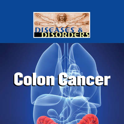 Colon Cancer