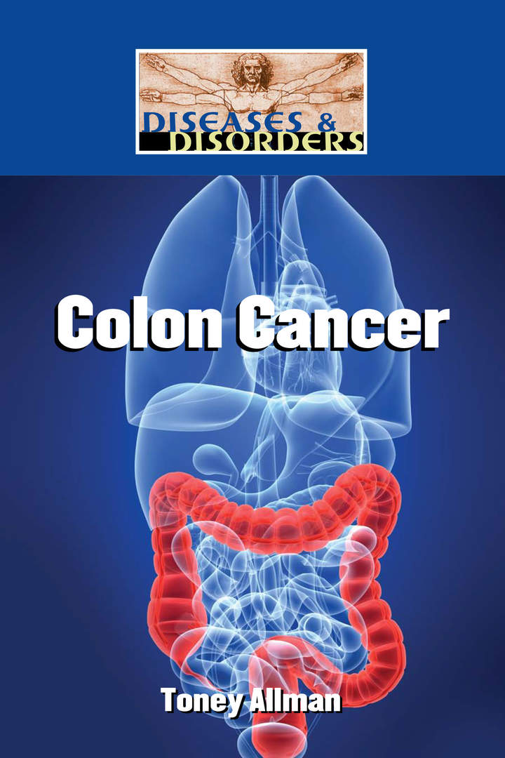 Colon Cancer