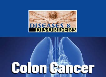 Colon Cancer